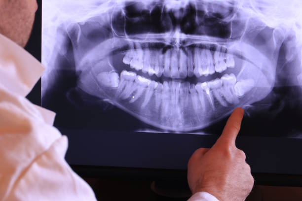 Best Emergency Tooth Extraction in Mebane, NC