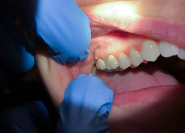 Best Emergency Tooth Extraction in Mebane, NC